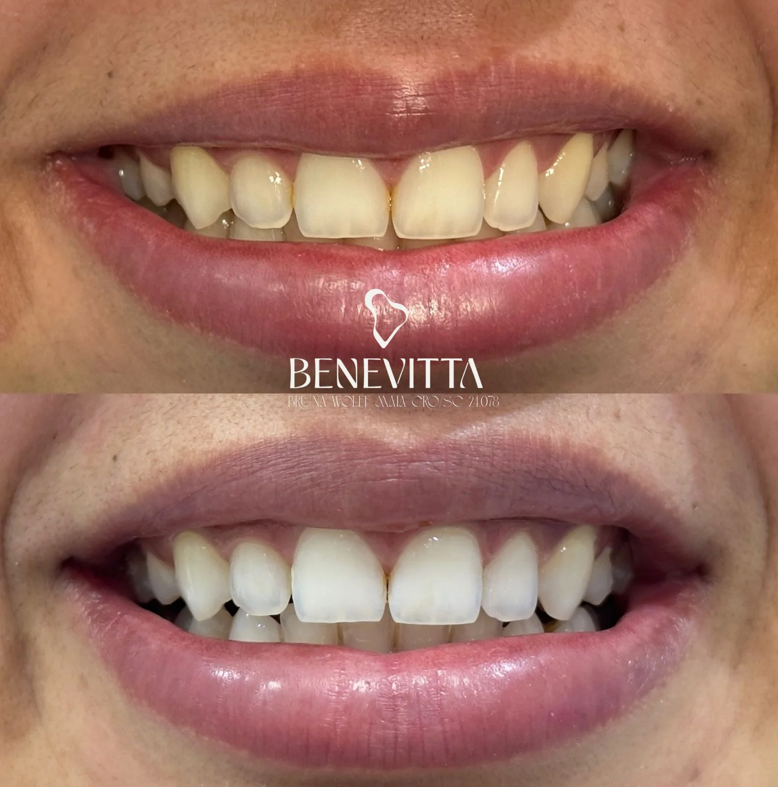 Harmonização facial com aplicação de toxina botulínica